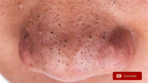 Search Massive Blackheads On Nose. . Popping massive blackheads on nose